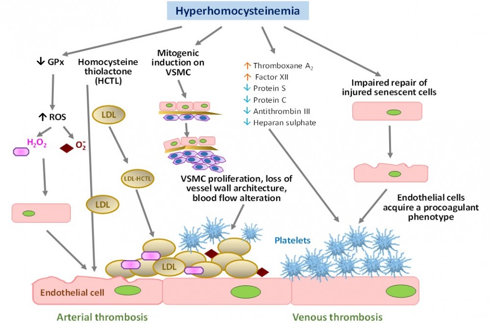 Figure 2: Main pathogenetic pathways of endothelial damage mediated by hyperhomocysteinemia
