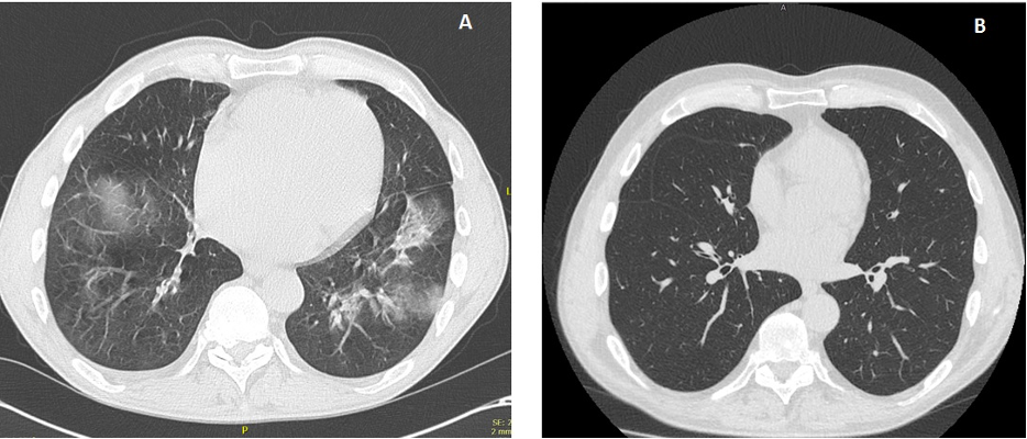 Figure 1: CT scan. 1A) Scan at the time of hospitalization: non-segmental peripheral and peri-bronchovascular consolidation with opacities and pleural connecting striae in the middle lobe and in the basal lobe of the lungs; 1B) Scan at the end of the induction phase: full resolution of the disease