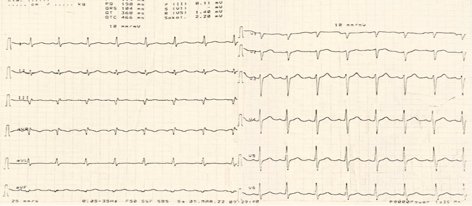 Figura 5: evidenza elettrocardiografica di allungamento del QTc