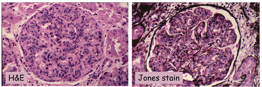 Figura 2. Microscopia ottica: glomerulonefrite proliferativa diffusa endocapillare e essudativa.
