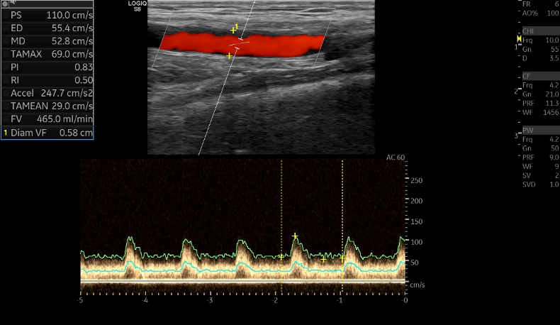 Figura 2: Color-doppler. Portata calcolata su arteria brachiale: 465ml/min; IR 0.5.