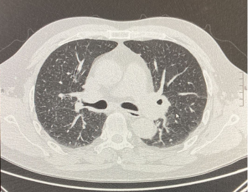 Figura 3: TC torace ottobre 2021; iniziale riduzione della componente fibrotica e nodulare polmonare.