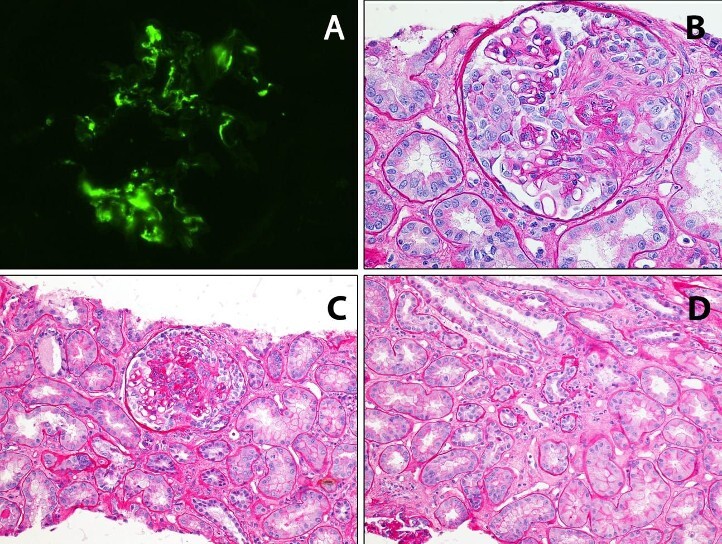 Quadro di glomerulonefrite compatibile con vasculite microscopica con pattern di danno prevalentemente