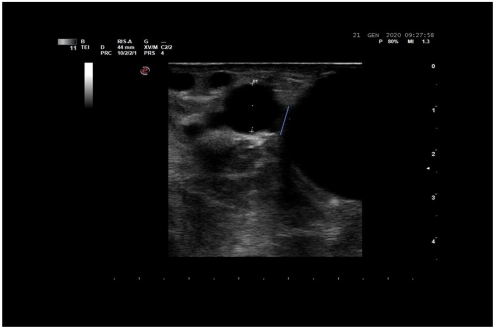 Immagine B-mode: si apprezza l’anastomosi e l’aneurisma post anastomosi, il diametro dell’arteria omerale è di 9,2 mm.