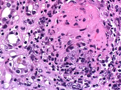 Figura 3: Glomerulo con semiluna fibro-cellulare (Ematossilina - Eosina - 20X).