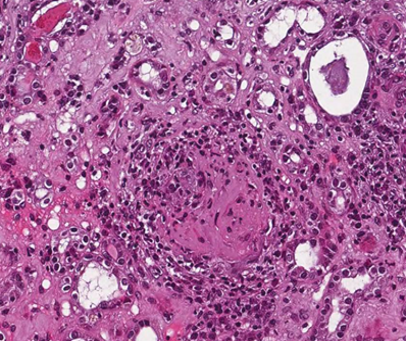 Figura 4: Glomerulo con semiluna fibrosa (Ematossilina - Eosina - 10X).