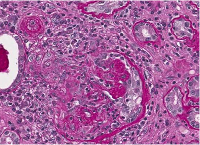 Glomerulo con rottura della capsula di Bowman; area di necrosi fibrinoide, semiluna fibro-cellulare; infiltrato periglomerulare 