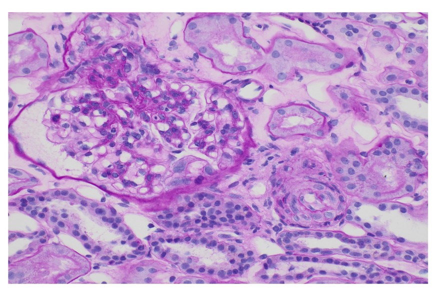 MO: frustule of cortical and renal medullary in which 7 glomeruli are observed, of which 2 are hyaline globally (29%).