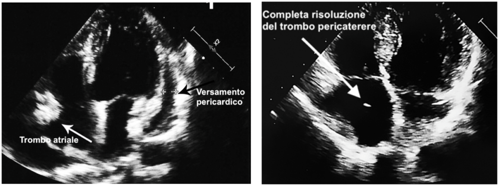 Voluminoso trombo atriale in paziente con infezione del CVC e lieve versamento pericardico