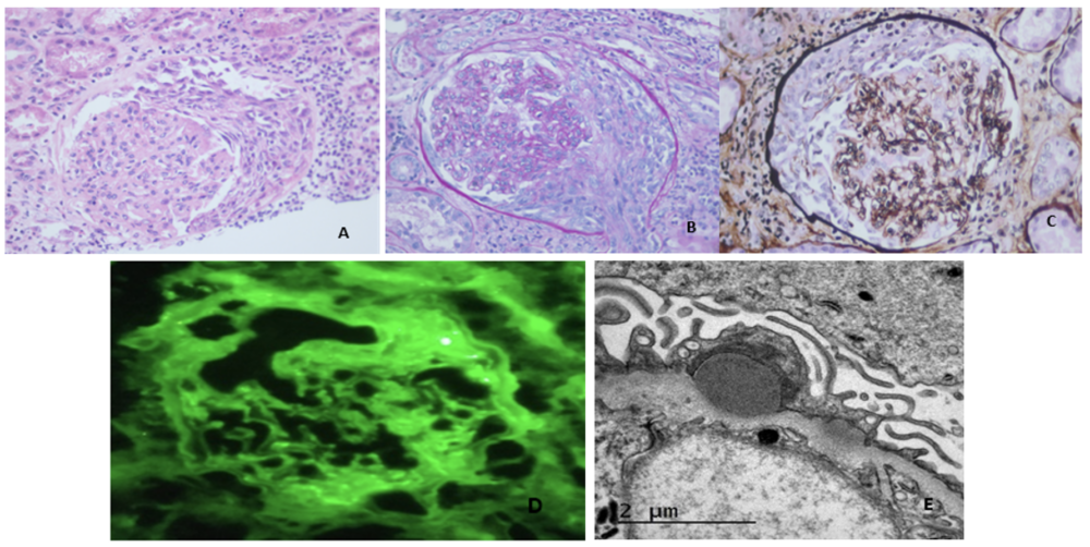 H&E 40X shows a glomerulus with mesangial and endocapillary proliferation. 55% of glomeruli with cellular stage crescents.